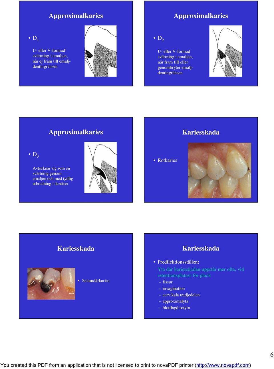 en svärtning genom emaljen och med tydlig utbredning i dentinet Kariesskada Kariesskada Sekundärkaries Predilektionsställen: Yta där