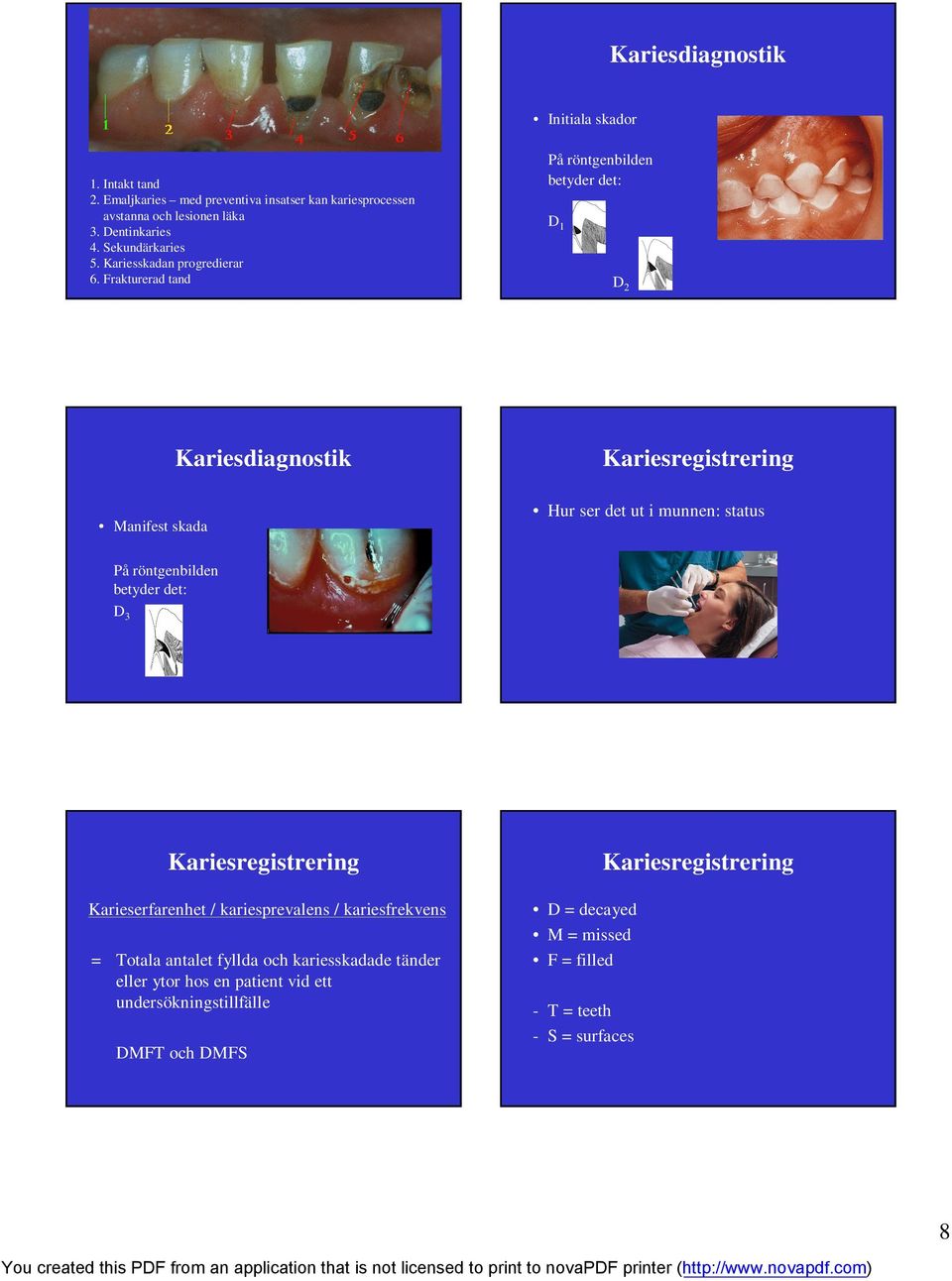 Frakturerad tand På röntgenbilden betyder det: D 1 D 2 Kariesdiagnostik Kariesregistrering Manifest skada Hur ser det ut i munnen: status På röntgenbilden
