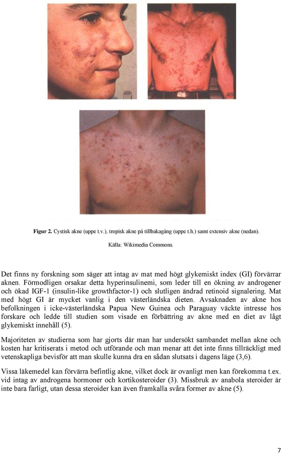 Förmodligen orsakar detta hyperinsulinemi, som leder till en ökning av androgener och ökad IGF-1 (insulin-like growthfactor-1) och slutligen ändrad retinoid signalering.