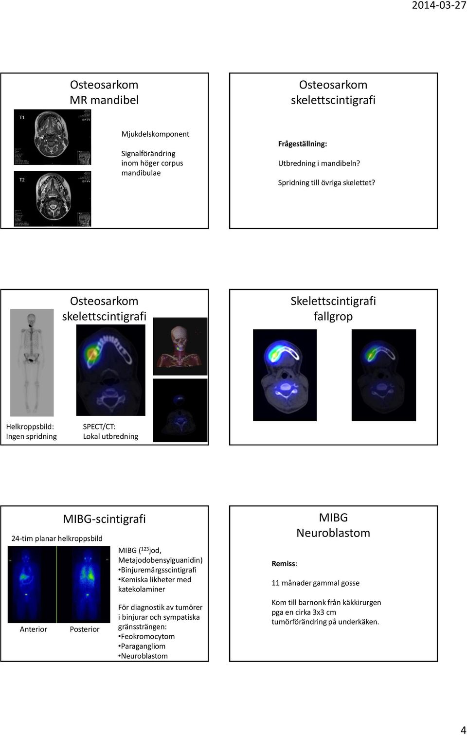 Osteosarkom skelettscintigrafi fallgrop Helkroppsbild: Ingen spridning SPECT/CT: Lokal utbredning 24-tim planar helkroppsbild Anterior MIBG-scintigrafi Posterior MIBG