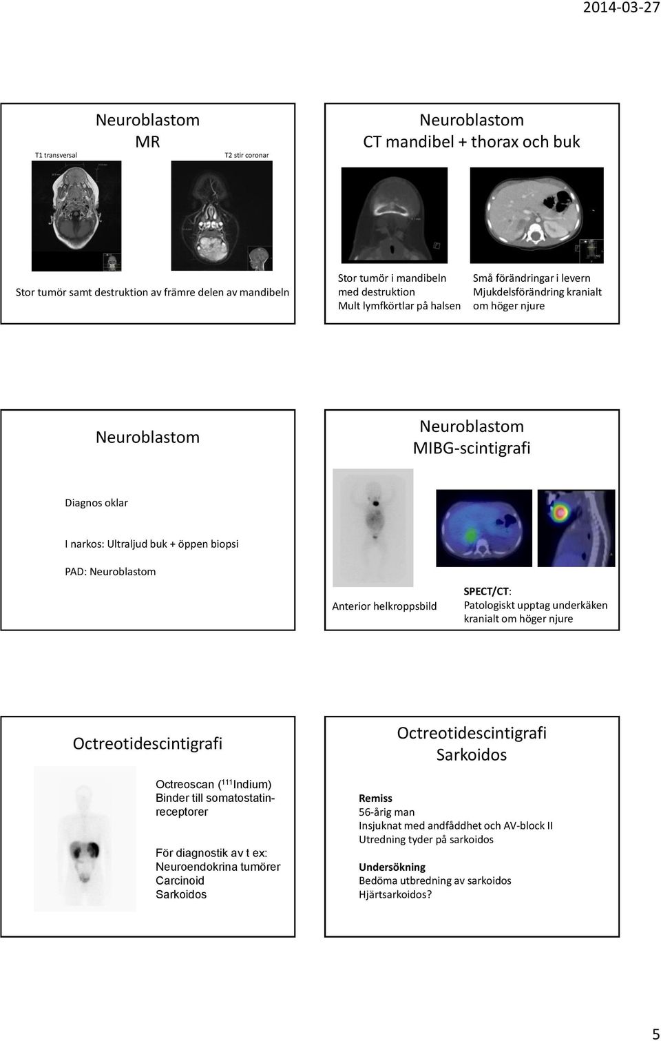 Patologiskt upptag underkäken kranialt om höger njure Octreotidescintigrafi Octreoscan ( 111 Indium) Binder till somatostatinreceptorer För diagnostik av t ex: Neuroendokrina tumörer