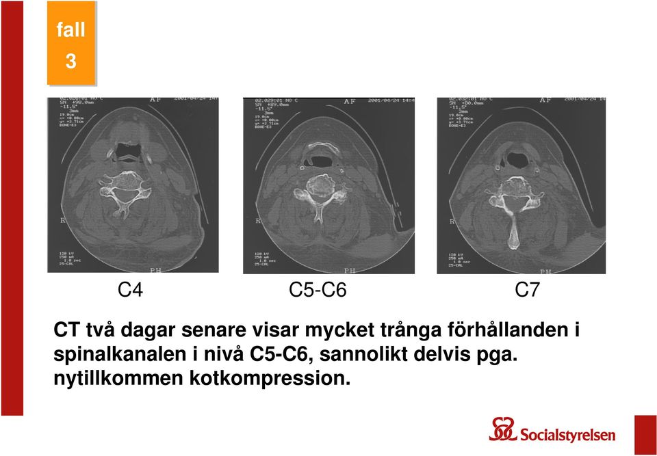 spinalkanalen i nivå C5-C6,