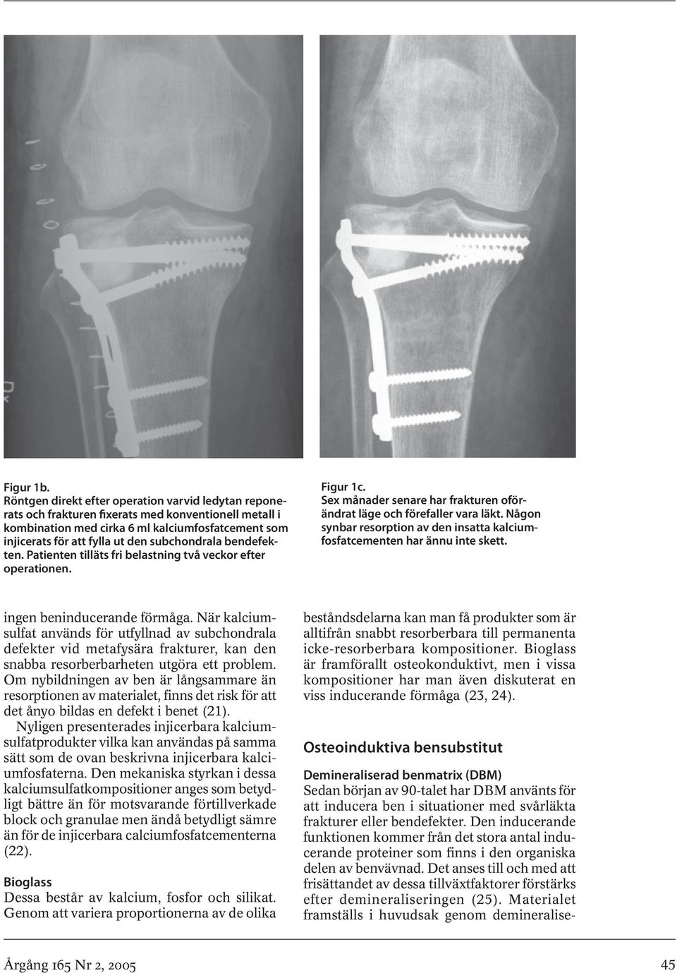 subchondrala bendefekten. Patienten tilläts fri belastning två veckor efter operationen. Figur 1c. Sex månader senare har frakturen oförändrat läge och förefaller vara läkt.