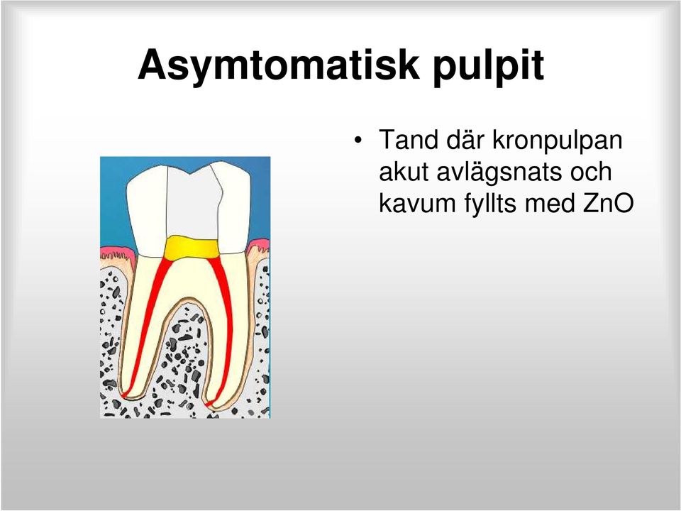 akut avlägsnats och