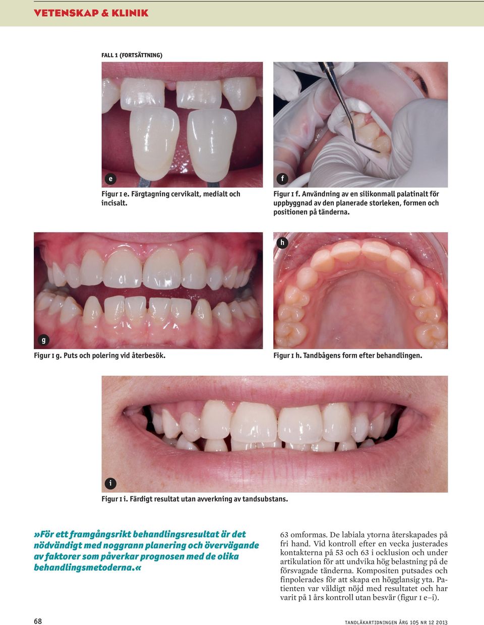 Tandbågens form efter behandlingen. i Figur i i. Färdigt resultat utan avverkning av tandsubstans.