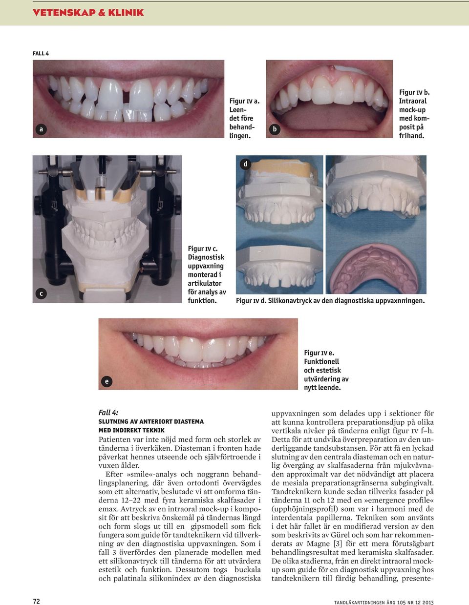 Fall 4: slutning av anteriort diastema med indirekt teknik Patienten var inte nöjd med form och storlek av tänderna i överkäken.