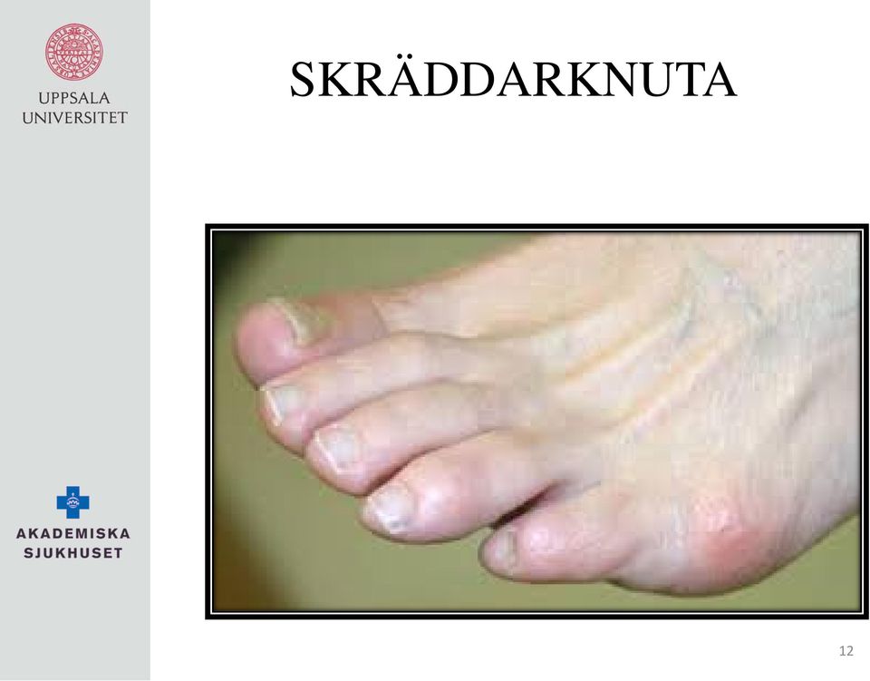 FOTKIRURGI. Linda Selberg Fotsektionen Ortopedkliniken UAS - PDF Free  Download