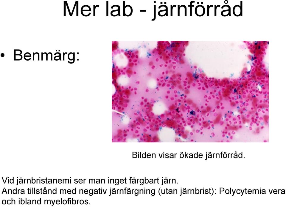 Vid järnbristanemi ser man inget färgbart järn.