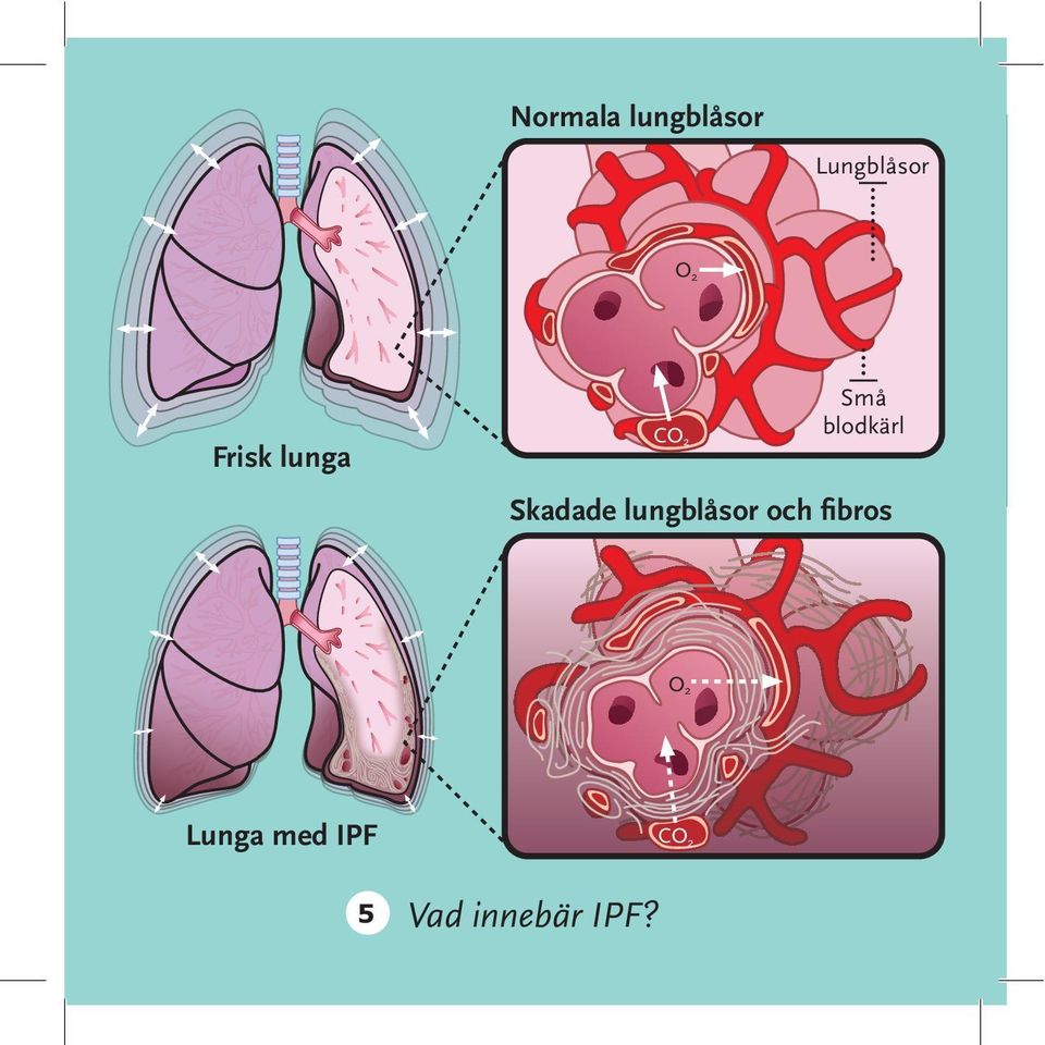 lungblåsor och fibros Information 13