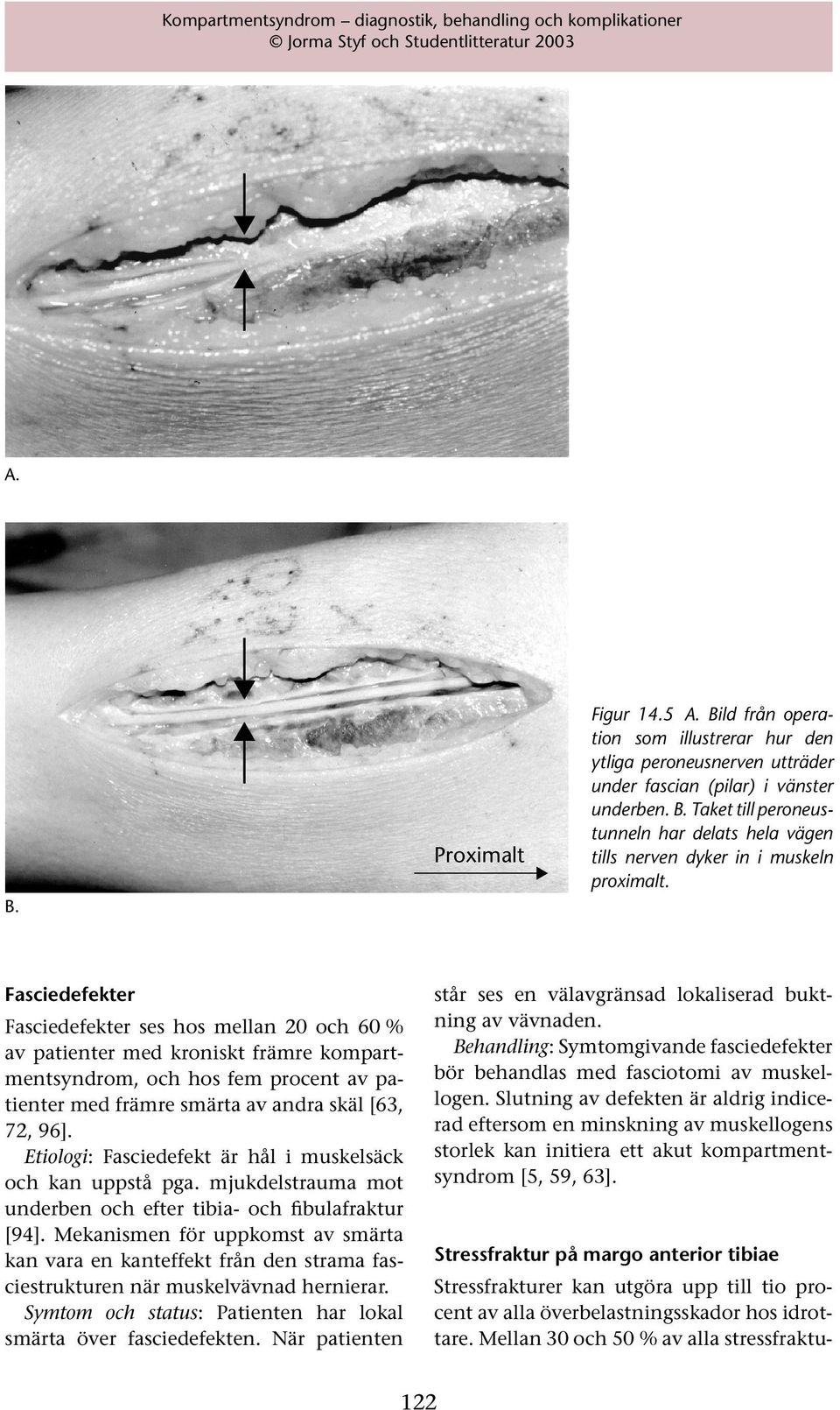 Etiologi: Fasciedefekt är hål i muskelsäck och kan uppstå pga. mjukdelstrauma mot underben och efter tibia- och fibulafraktur [94].