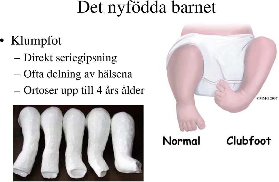 seriegipsning Ofta