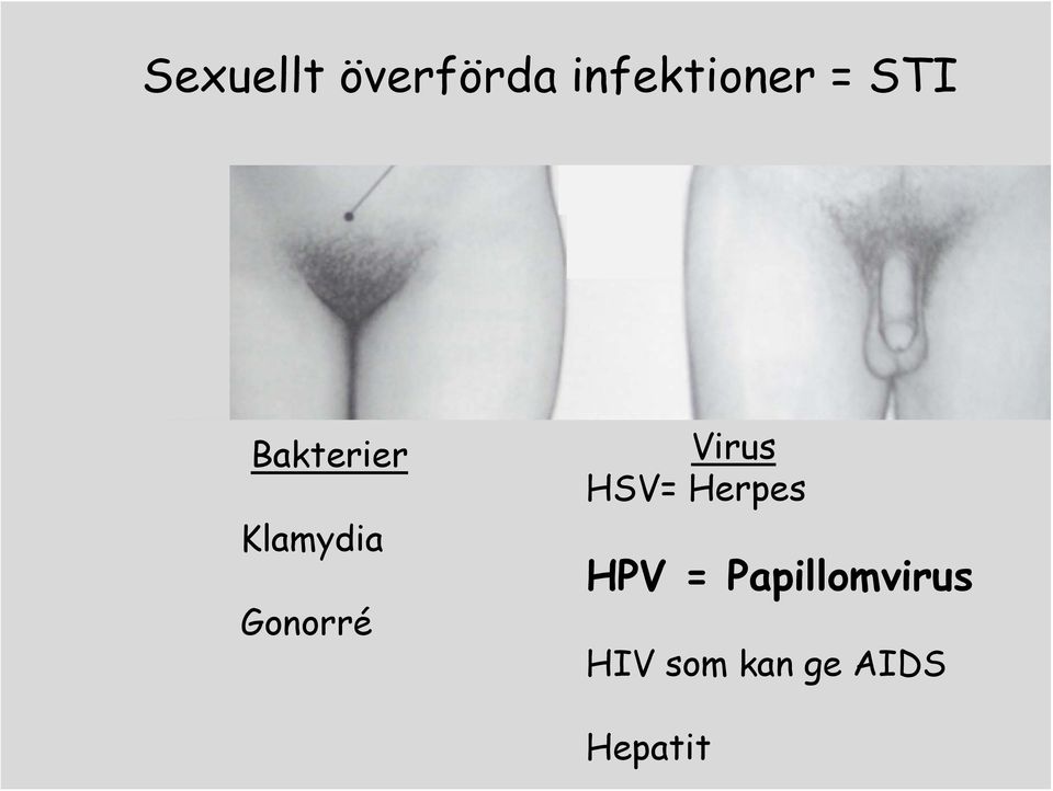 Virus HSV= Herpes HPV =