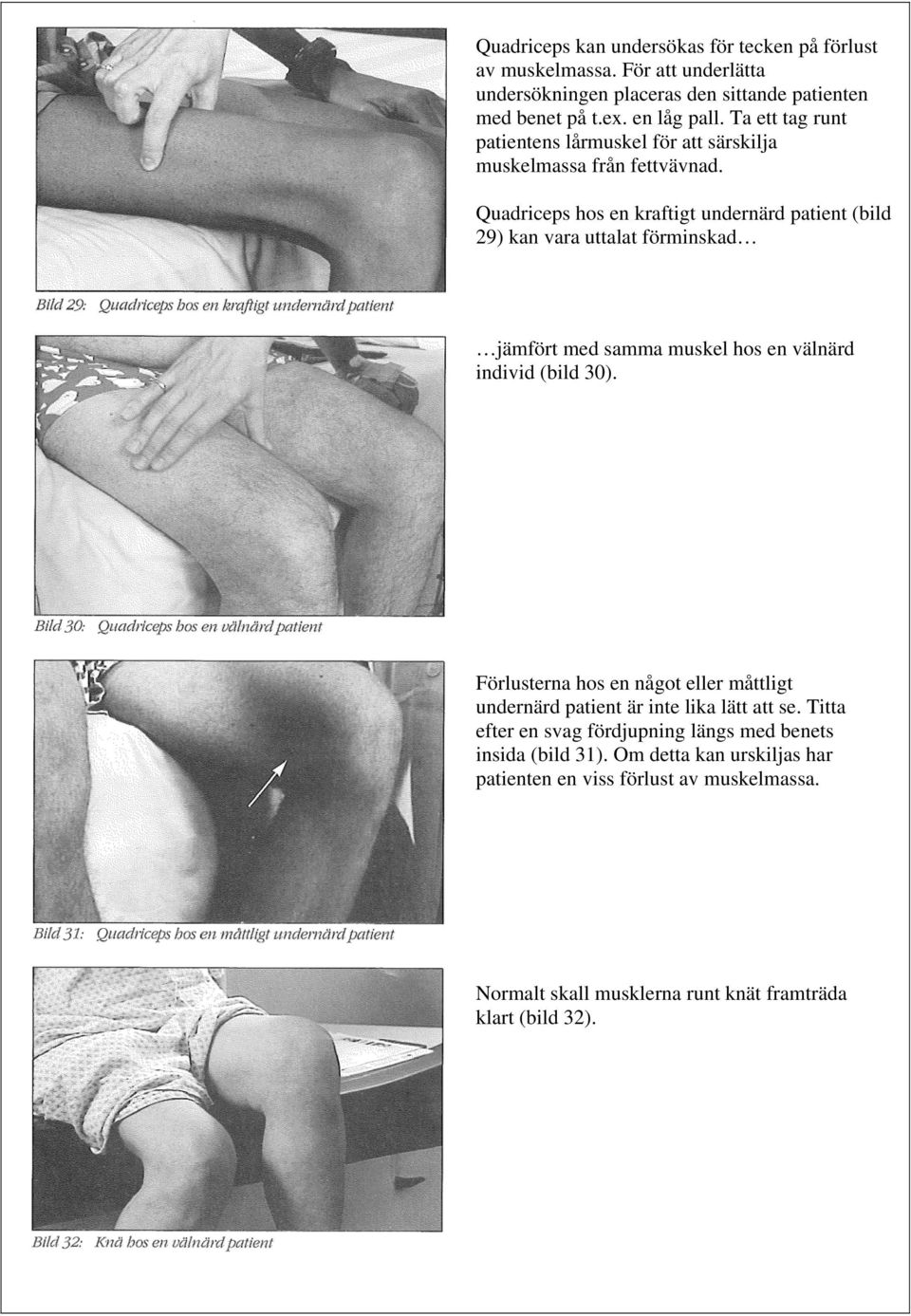 Quadriceps hos en kraftigt undernärd patient (bild 29) kan vara uttalat förminskad jämfört med samma muskel hos en välnärd individ (bild 30).