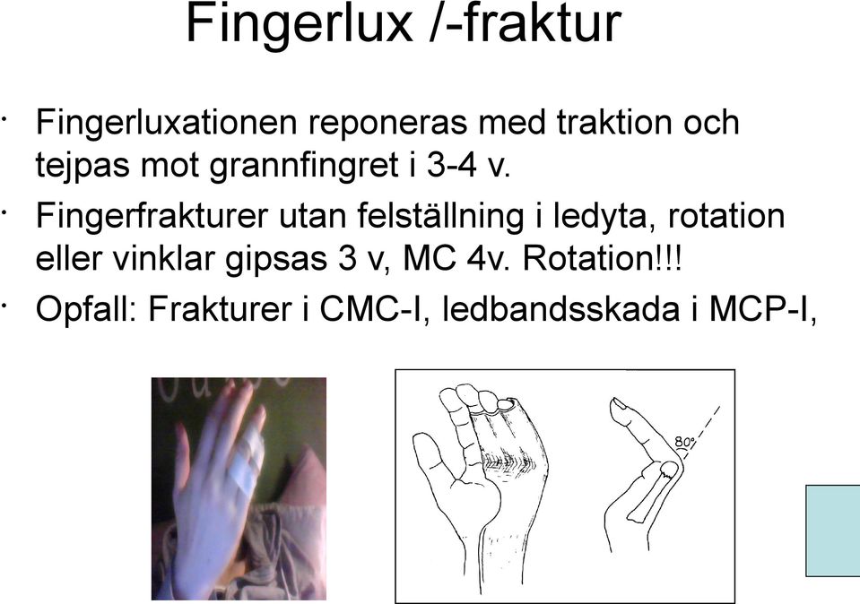 Fingerfrakturer utan felställning i ledyta, rotation eller
