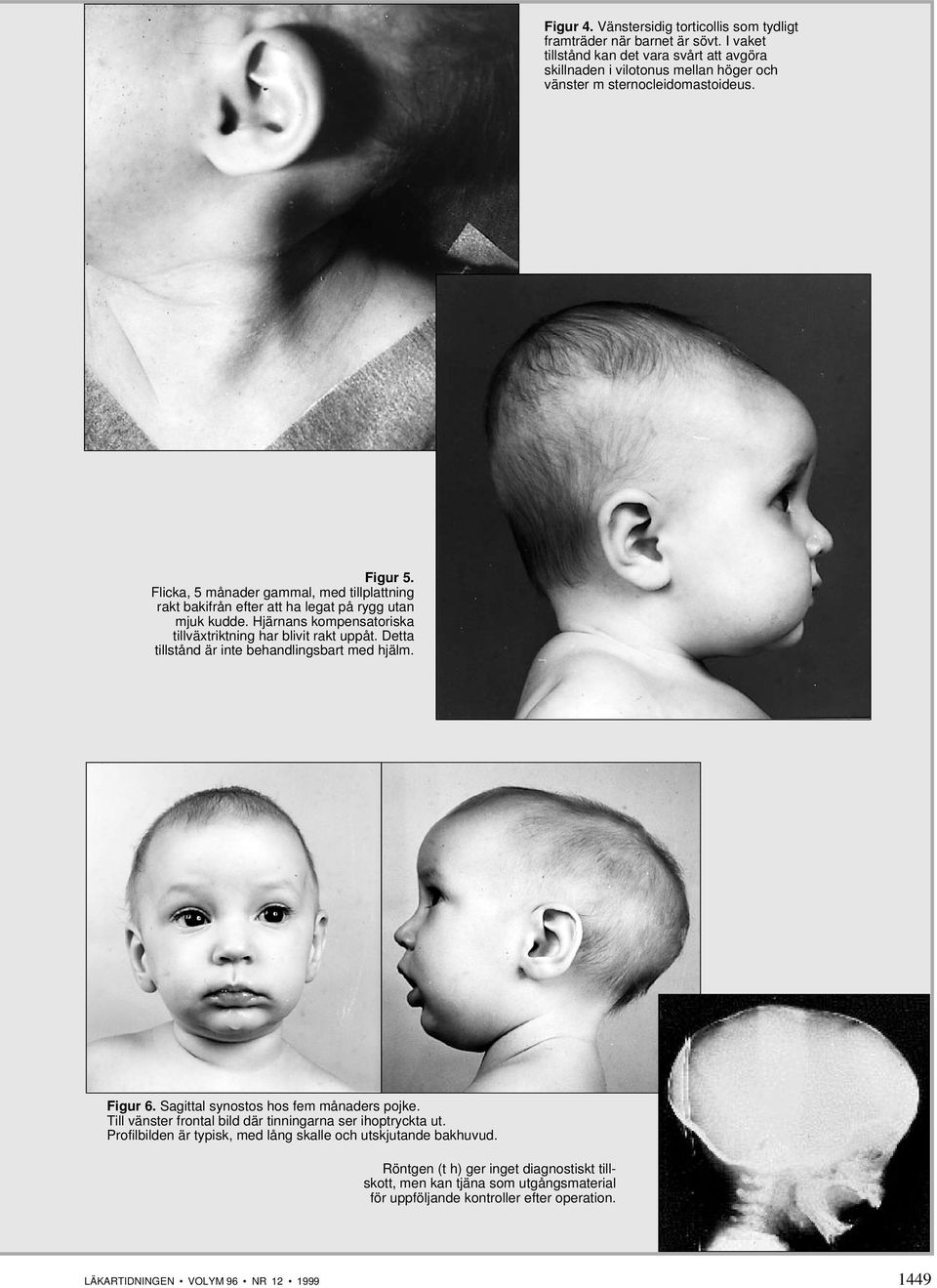 Flicka, 5 månader gammal, med tillplattning rakt bakifrån efter att ha legat på rygg utan mjuk kudde. Hjärnans kompensatoriska tillväxtriktning har blivit rakt uppåt.