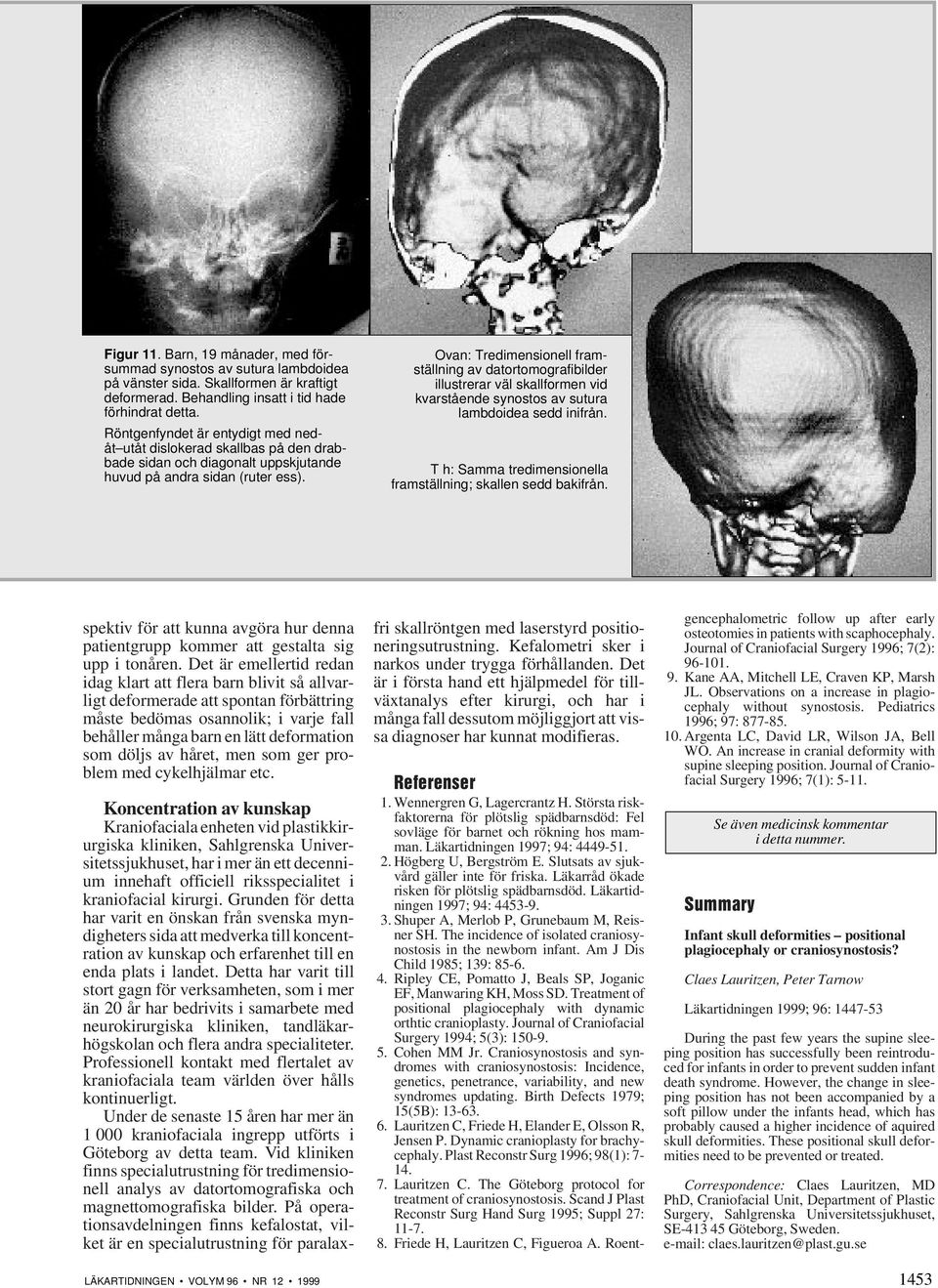 Ovan: Tredimensionell framställning av datortomografibilder illustrerar väl skallformen vid kvarstående synostos av sutura lambdoidea sedd inifrån.