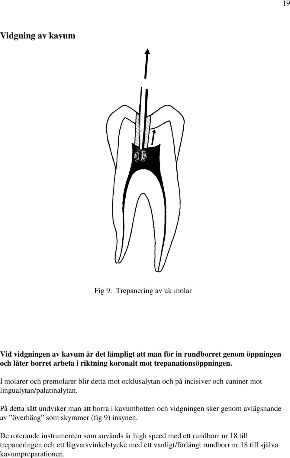 trepanationsöppningen. I molarer och premolarer blir detta mot ocklusalytan och på incisiver och caniner mot lingualytan/palatinalytan.