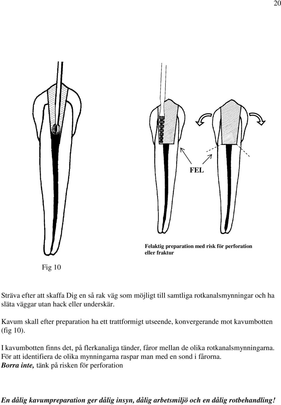 Kavum skall efter preparation ha ett trattformigt utseende, konvergerande mot kavumbotten (fig 10).