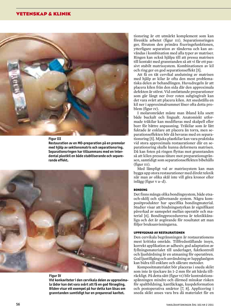 Separationsringen ger, förutom den primära fixeringsfunktionen, ytterligare separation av tänderna och kan användas i kombination med alla typer av matriser.