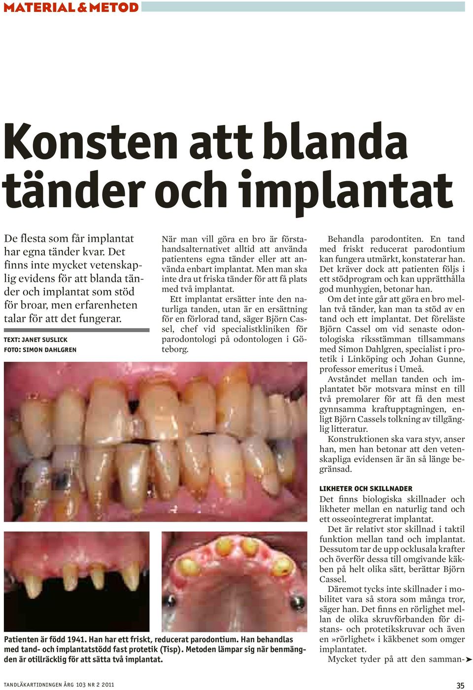 Text: Janet Suslick Foto: Simon Dahlgren När man vill göra en bro är förstahandsalternativet alltid att använda patientens egna tänder eller att använda enbart implantat.