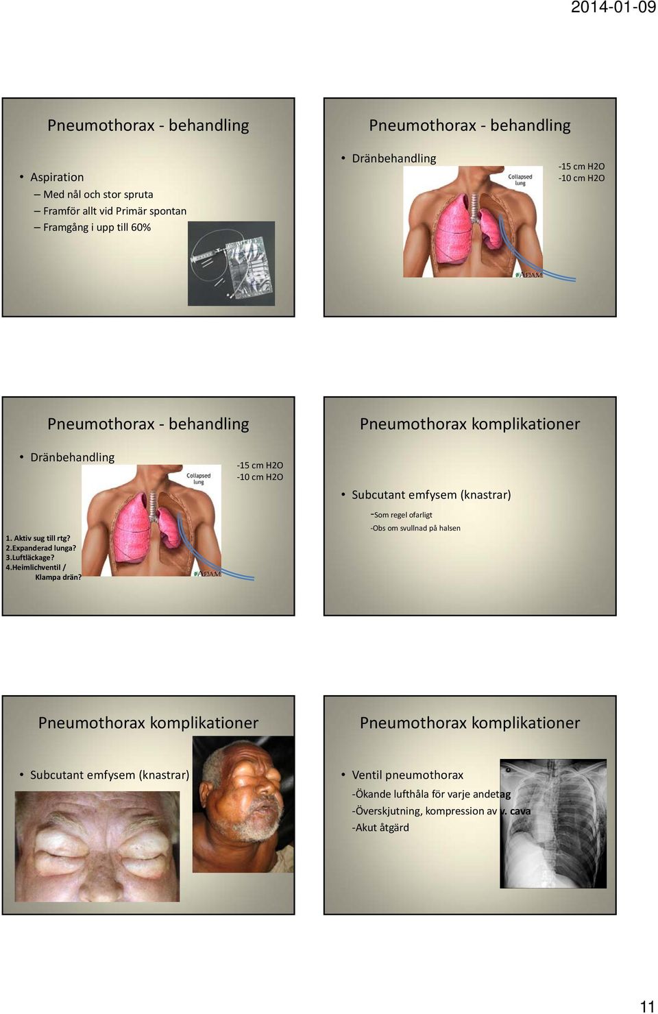 15 cm H2O 10 cm H2O Subcutant emfysem (knastrar) Som regel ofarligt Obs om svullnad på halsen 63 64 Pneumothorax komplikationer Pneumothorax komplikationer Subcutant emfysem (knastrar) Som regel