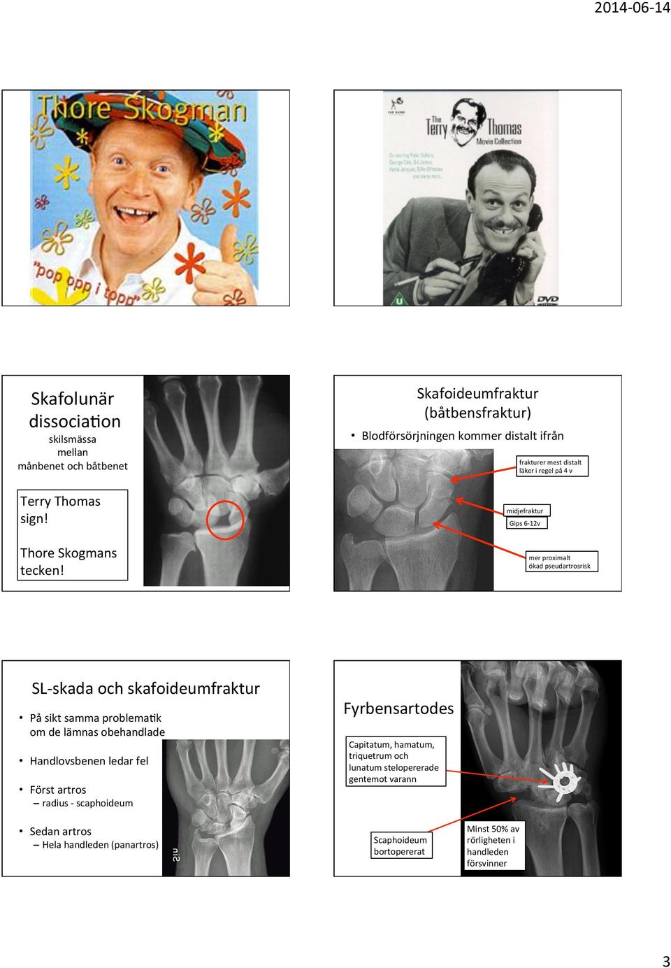 pseudartrosrisk SL- skada och skafoideumfraktur På sikt samma problemaxk om de lämnas obehandlade Handlovsbenen ledar fel Först artros radius - scaphoideum