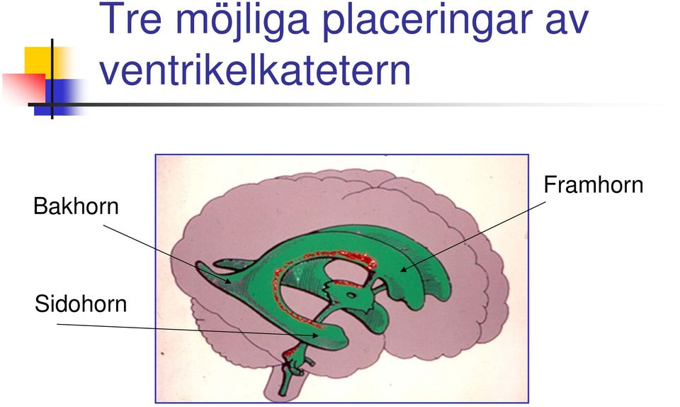 ventrikelkatetern