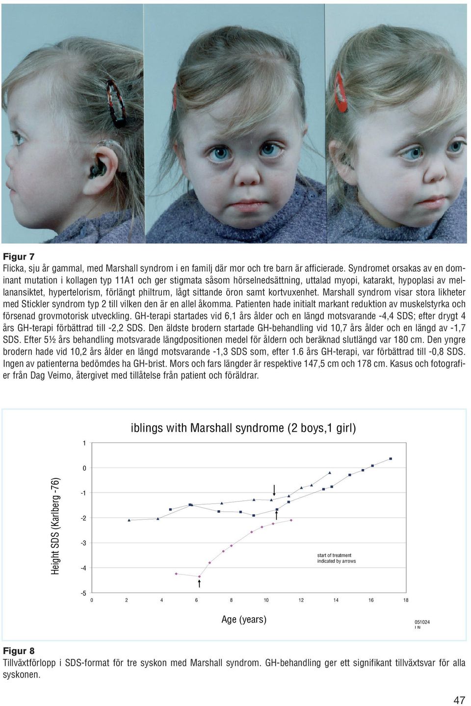 sittande öron samt kortvuxenhet. Marshall syndrom visar stora likheter med Stickler syndrom typ 2 till vilken den är en allel åkomma.