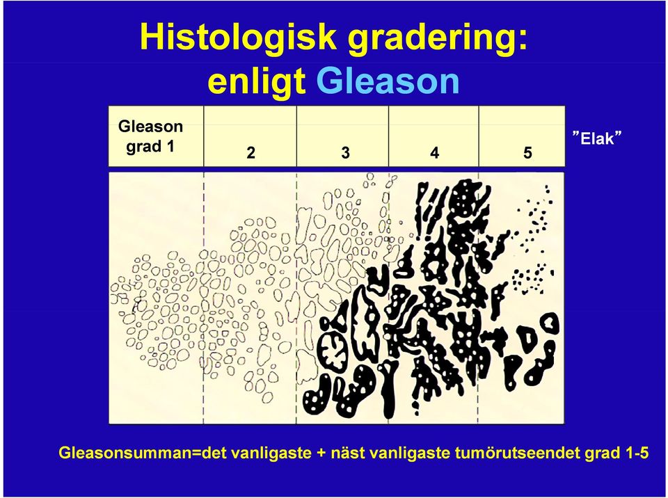 Elak Gleasonsumman=det vanligaste