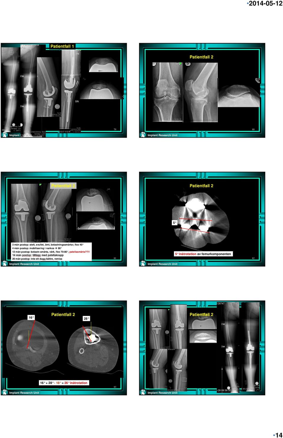 flex 70-80, patellasmärta?