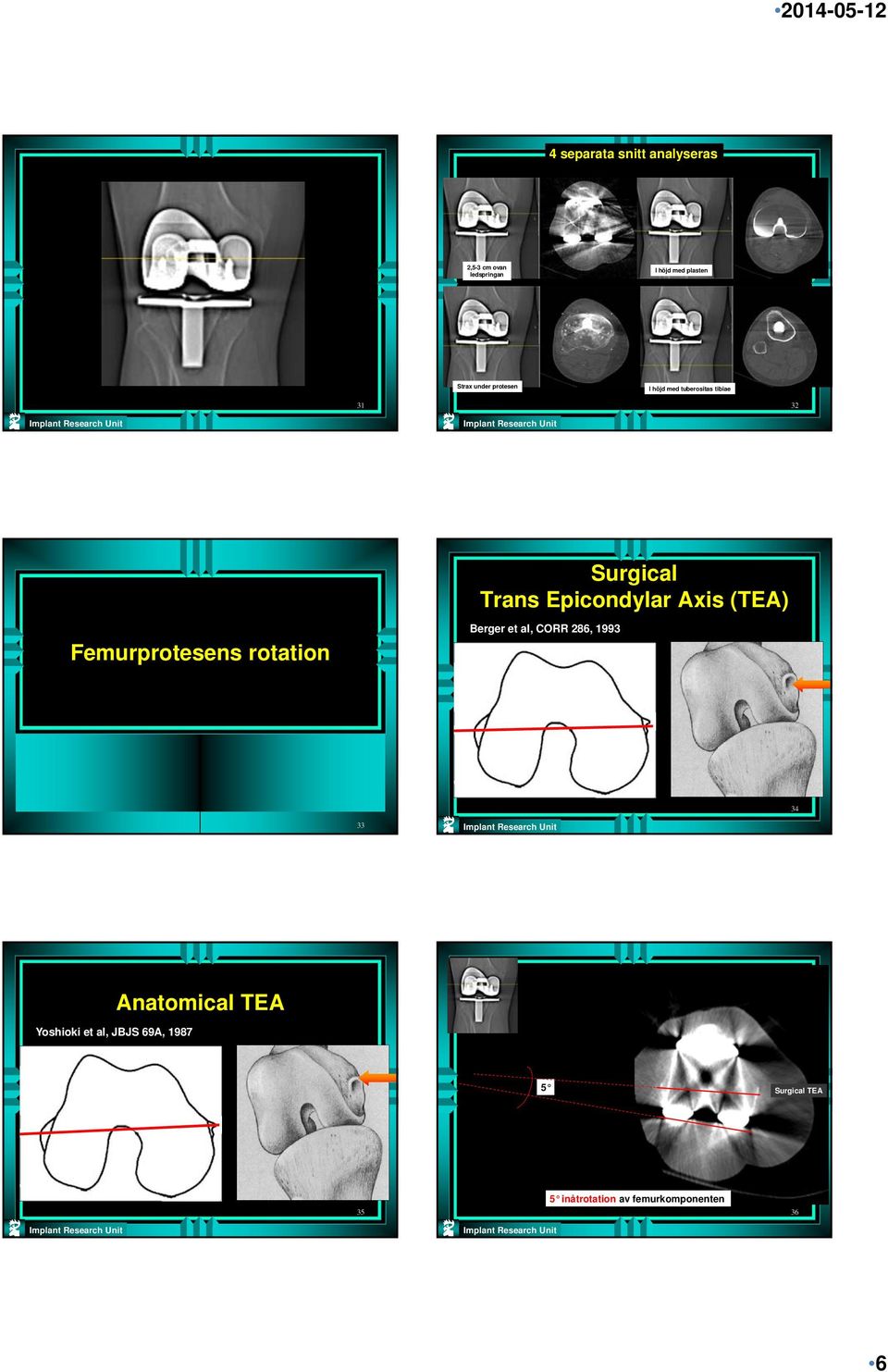 (TEA) Femurprotesens rotation Berger et al, CORR 286, 1993 34 33 Yoshioki et al,