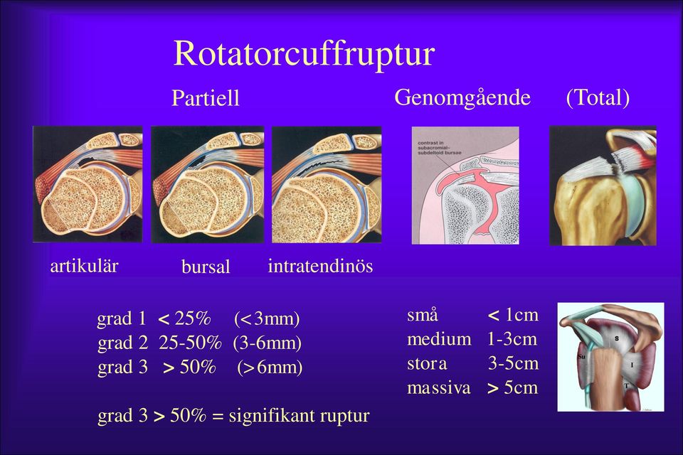 (3-6mm) grad 3 > 50% (>6mm) grad 3 > 50% = signifikant