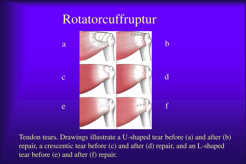 after (b) repair, a crescentic tear before (c) and