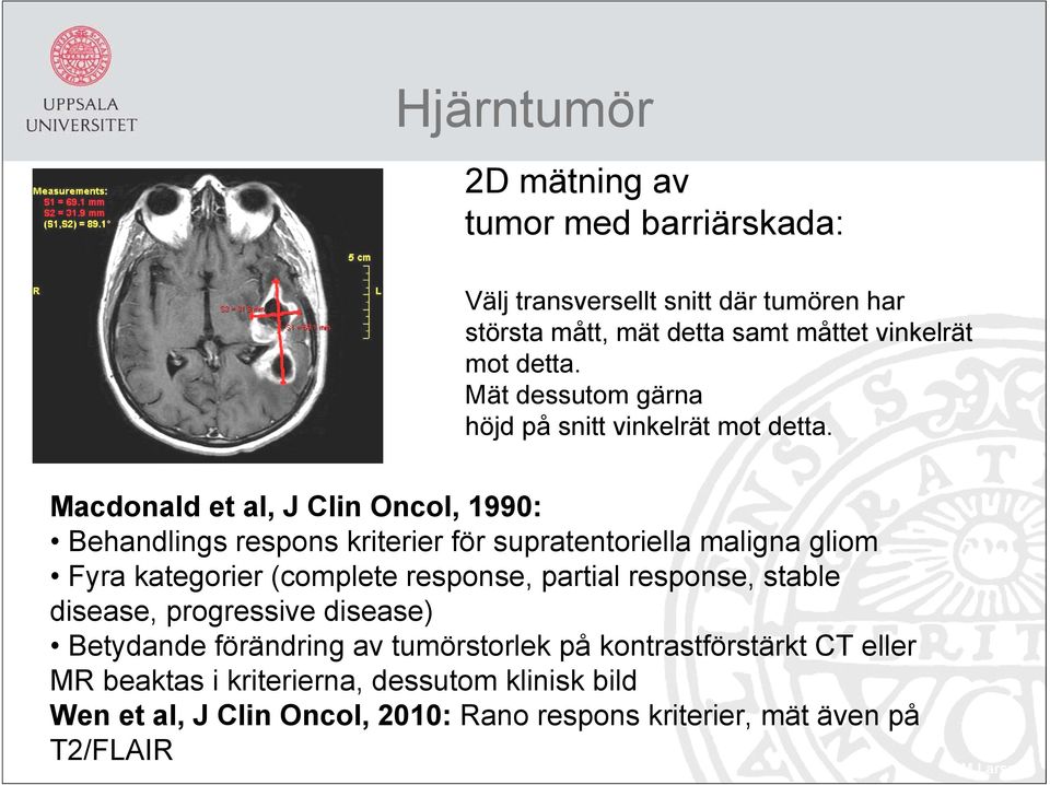 Macdonald et al, J Clin Oncol, 1990: Behandlings respons kriterier för supratentoriella maligna gliom Fyra kategorier (complete response, partial