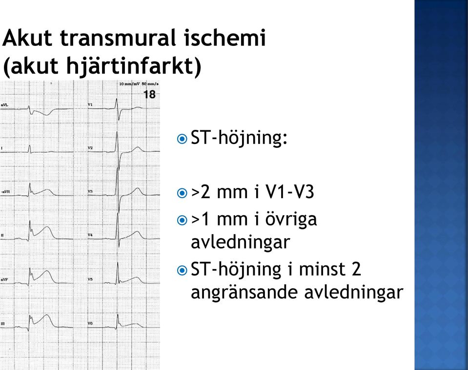 V1-V3 >1 mm i övriga avledningar