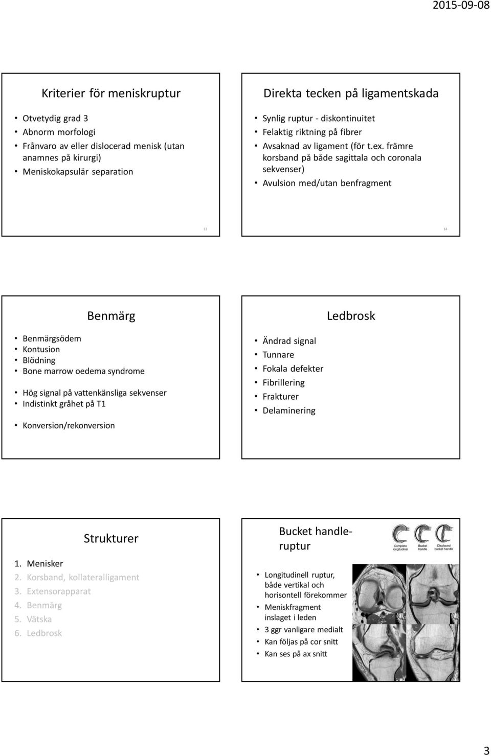 främre korsband på både sagittala och coronala sekvenser) Avulsion med/utan benfragment 13 14 Benmärg Ledbrosk Benmärgsödem Kontusion Blödning Bone marrow oedema syndrome Hög signal på vattenkänsliga