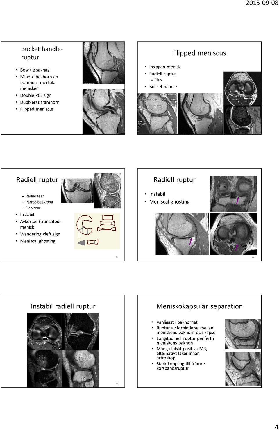 ghosting Radiell ruptur Instabil Meniscal ghosting 21 22 Instabil radiell ruptur Meniskokapsulär separation Vanligast i bakhornet Ruptur av förbindelse mellan meniskens