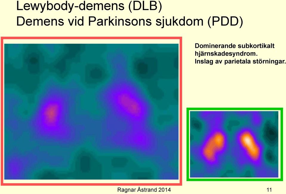 Dominerande subkortikalt