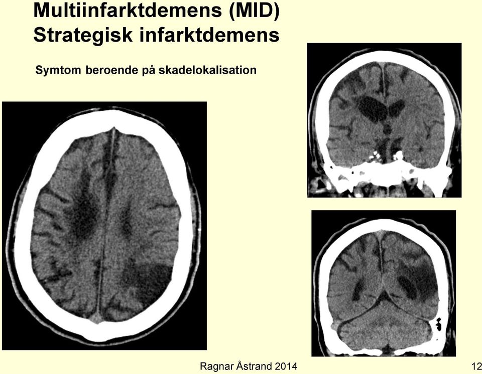 infarktdemens Symtom