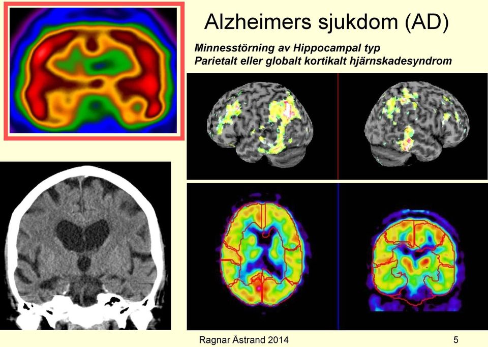 Hippocampal typ Parietalt