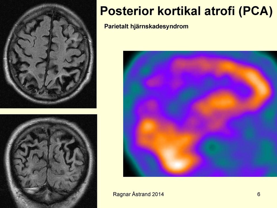 (PCA) Parietalt