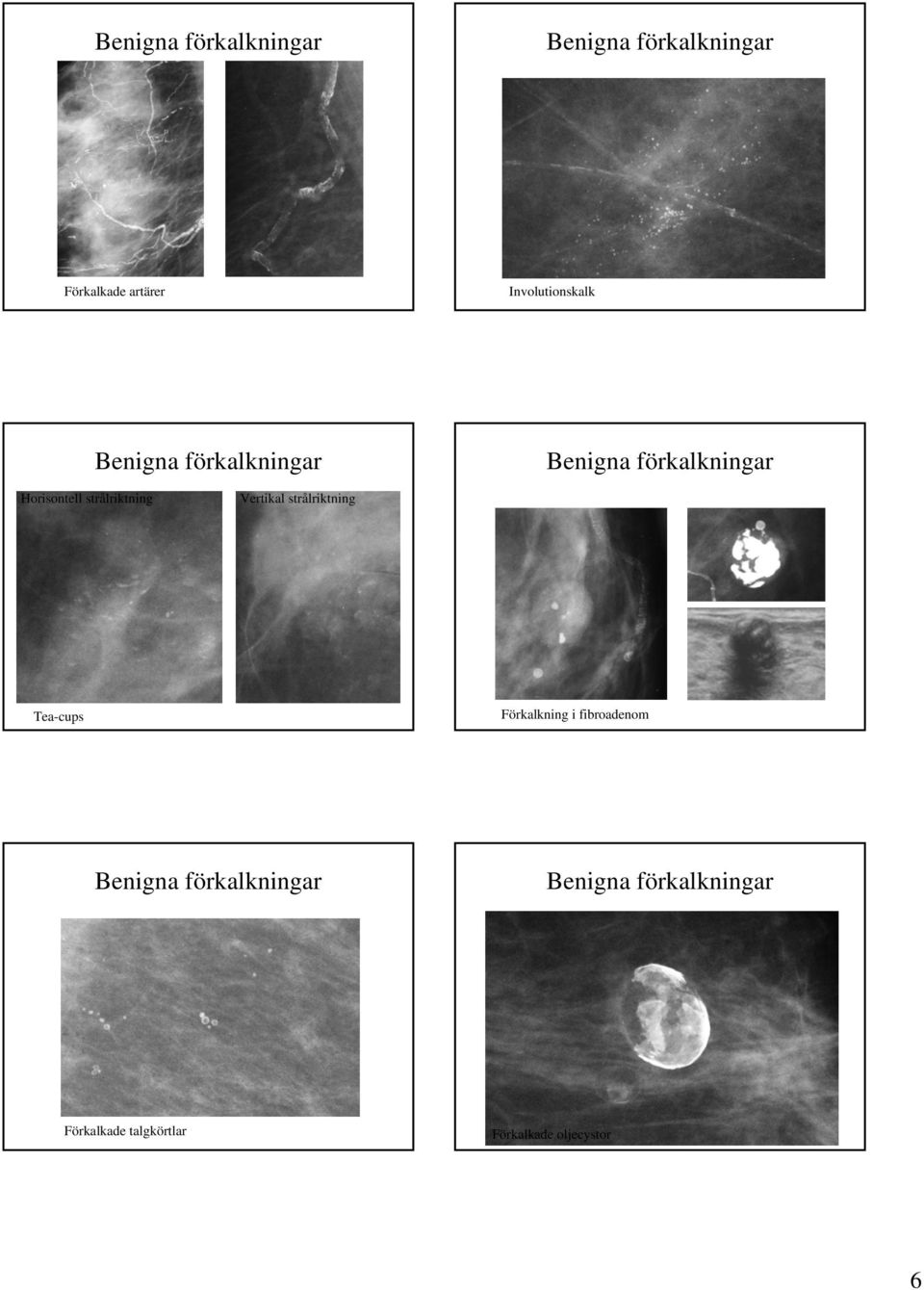 strålriktning Vertikal strålriktning Tea-cups Förkalkning i fibroadenom