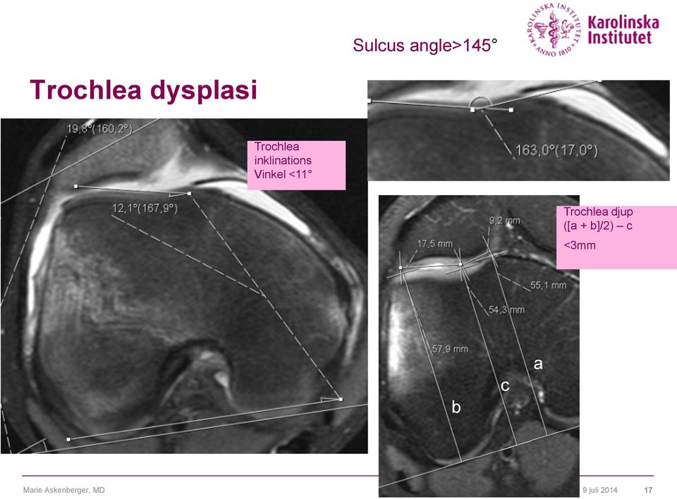 Trochlea djup ([a + b]/2) c <3mm b