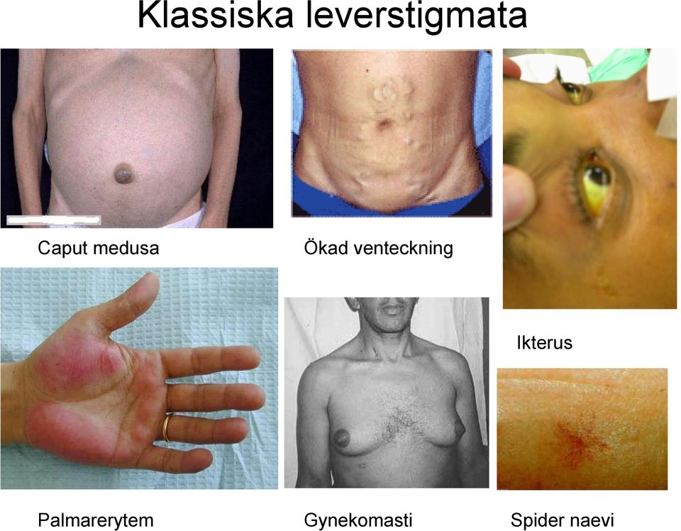 venteckning Ikterus
