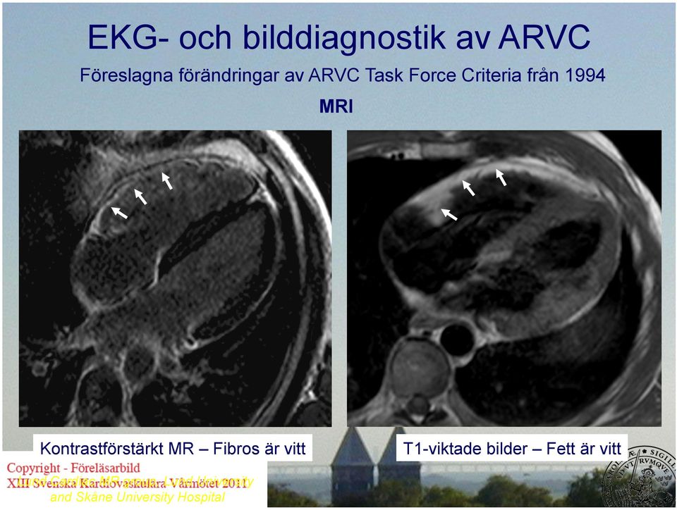 MRI Kontrastförstärkt MR Fibros