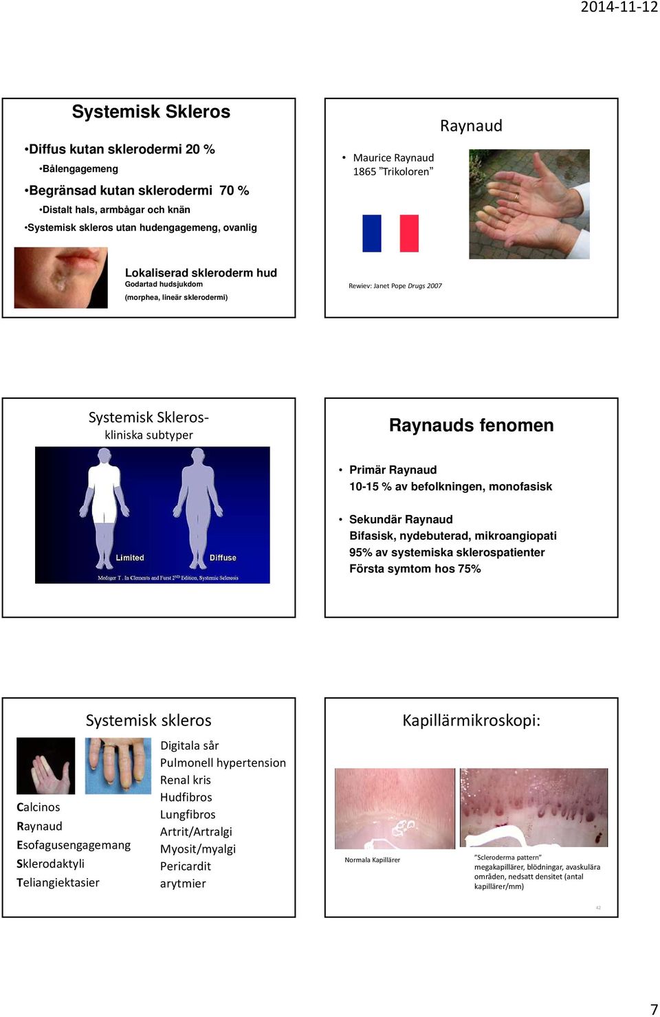 % av befolkningen, monofasisk Sekundär Raynaud Bifasisk, nydebuterad, mikroangiopati 95% av systemiska sklerospatienter Första symtom hos 75% Calcinos Raynaud Esofagusengagemang Sklerodaktyli