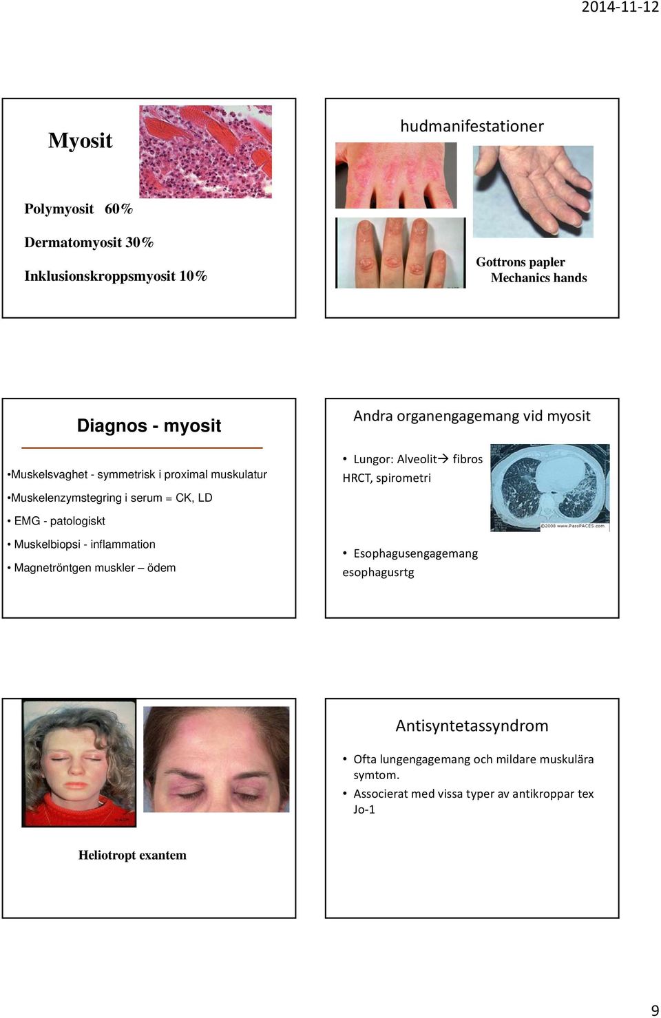 Muskelenzymstegring i serum = CK, LD EMG - patologiskt Muskelbiopsi - inflammation Magnetröntgen muskler ödem Esophagusengagemang