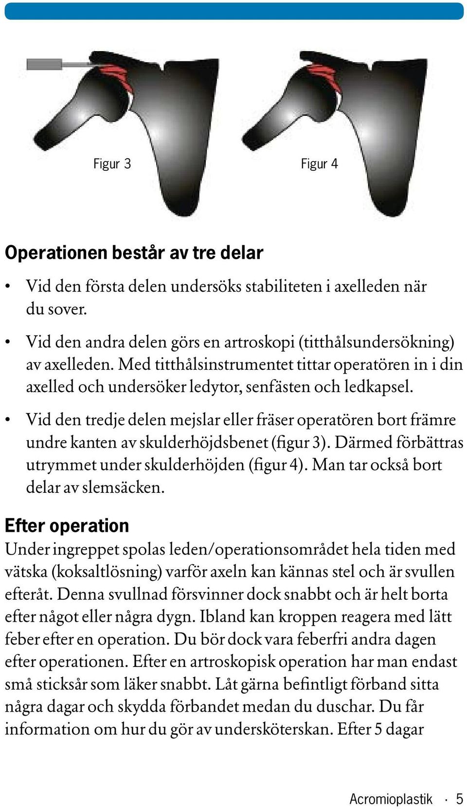 Vid den tredje delen mejslar eller fräser operatören bort främre undre kanten av skulderhöjdsbenet (figur 3). Därmed förbättras utrymmet under skulderhöjden (figur 4).