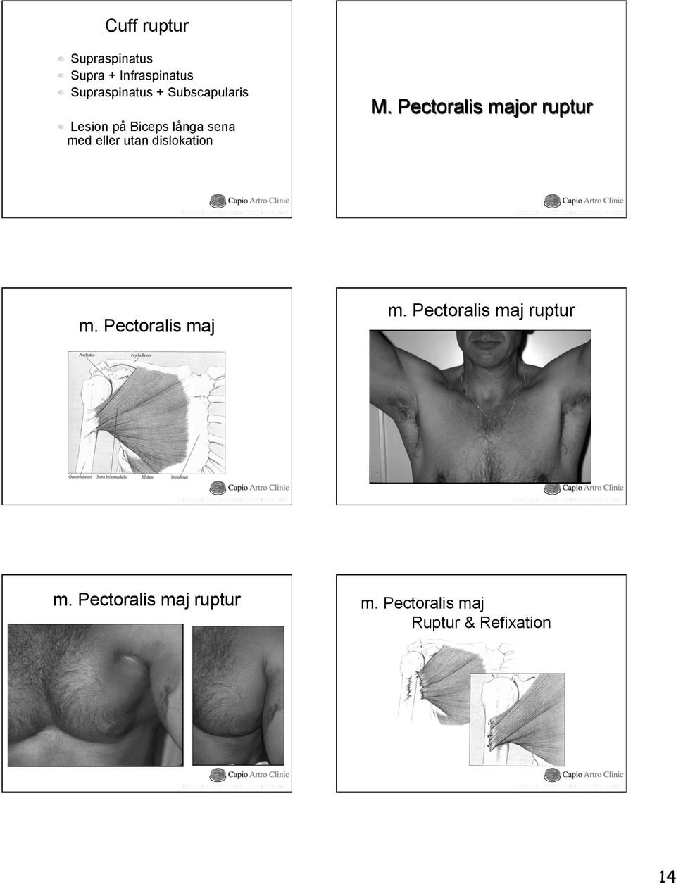 Lesion på Biceps långa sena med eller utan dislokation M.