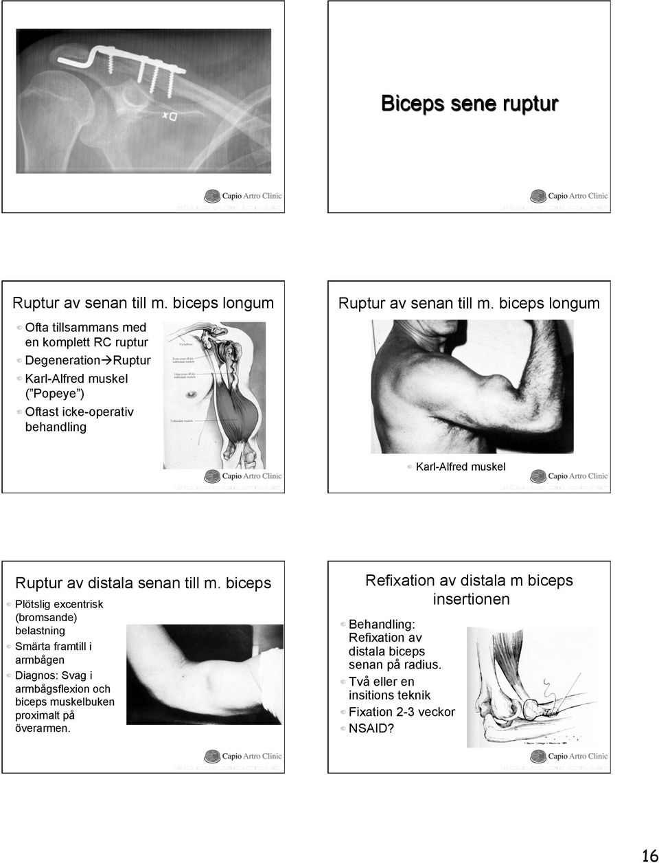 Plötslig excentrisk (bromsande) belastning! Smärta framtill i armbågen! Diagnos: Svag i armbågsflexion och biceps muskelbuken proximalt på överarmen.